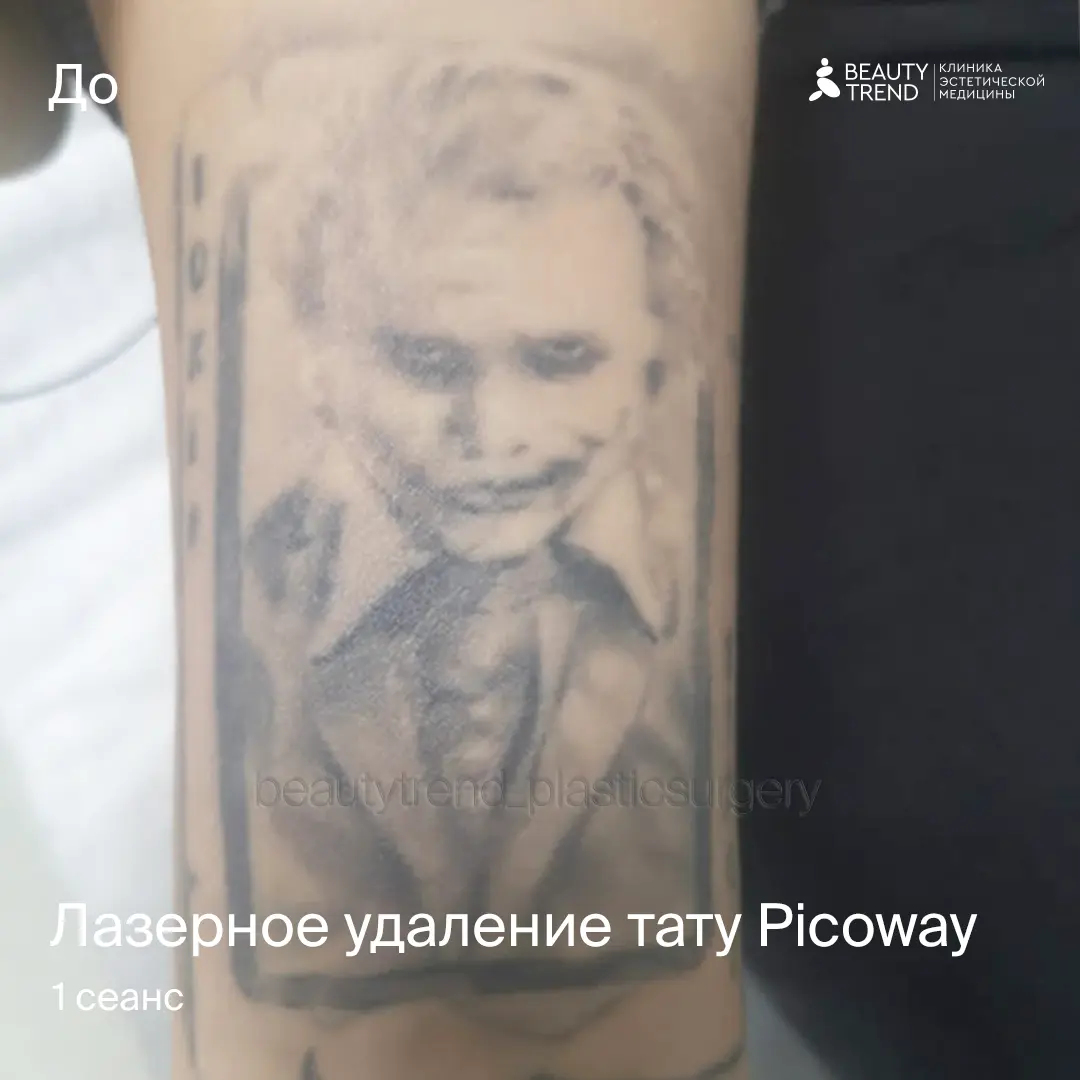 Удаление тату Picoway, 1С, работа до